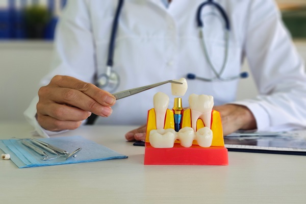 Oral Hygiene Routines For Dental Implants